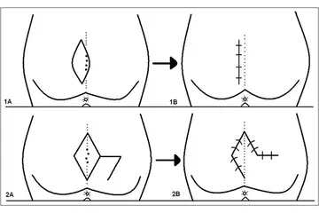 Pilonidal Sinüs Belirtileri ve Tedavisi